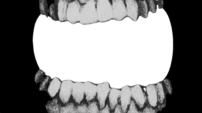 Teeth Frame Overlay